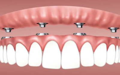 Impianto dentale – Tutto quello che devi sapere