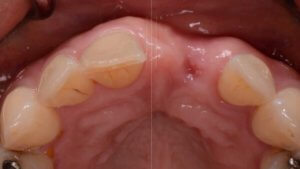 Implantologia 3D - Applicazione dei modelli Oral3D nel campo delle terapie implantari